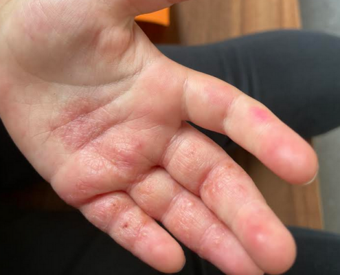 Eczeem probiotica
